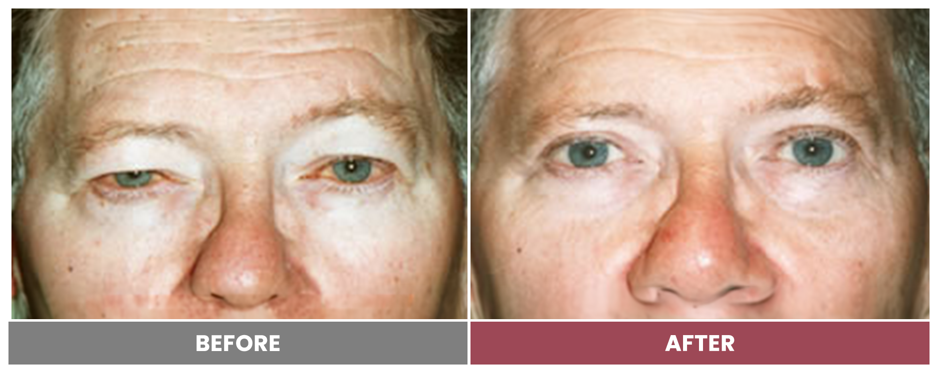 Upper Blepharoplasty - Case 66
